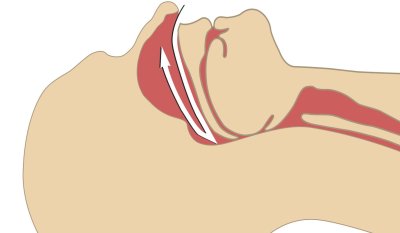 During sleep, the soft tissues in the throat vibrate, resulting in the irritating snoring sound